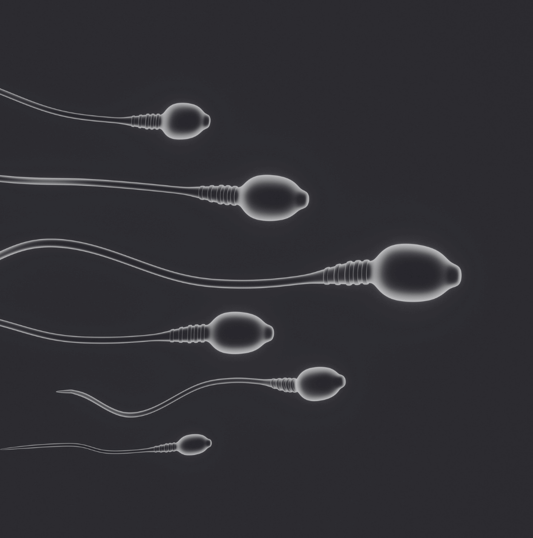 Sperm swimming freely after verecocele surgery