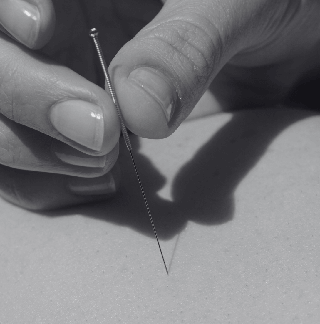 Acupuncture needle insertion for fertility